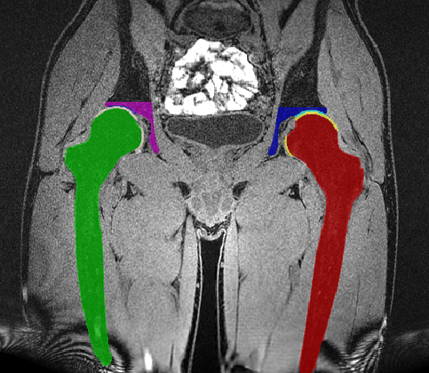 Hip Segmentation